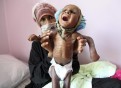 Watoto 85,000 wamekufa kwa njaa Yemen kutokana na mashambulio ya kijeshi ya Saudia